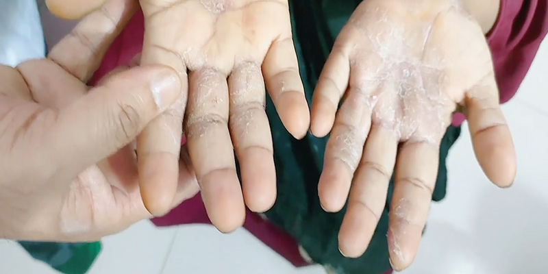 কোন ভিটামিনের অভাবে চর্মরোগ হয়